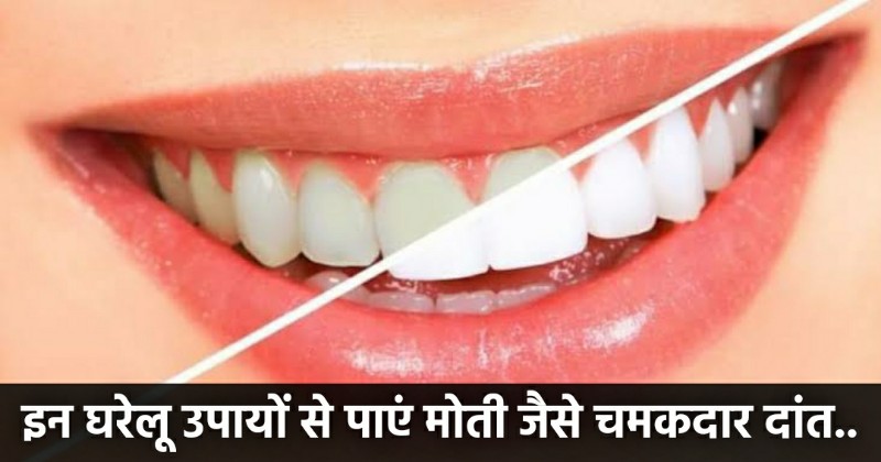 How Remove Strains From Teeth