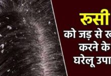 Dandruff Ko Dur Karne Ke Ghrelu Upaay