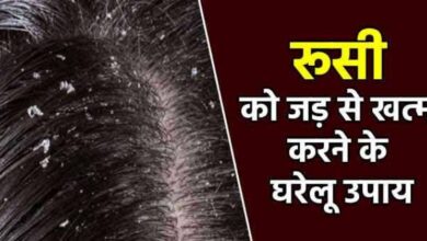 Dandruff Ko Dur Karne Ke Ghrelu Upaay