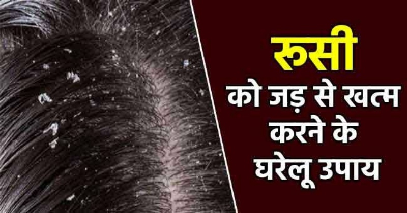 Dandruff Ko Dur Karne Ke Ghrelu Upaay